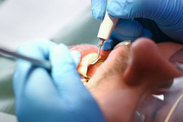 Best Emergency Wisdom Teeth Removal in Nanticoke, PA